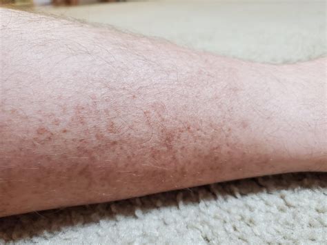brown spots on lower legs pictures